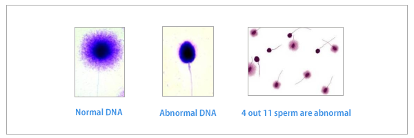 정자 DNA 절편화 검사