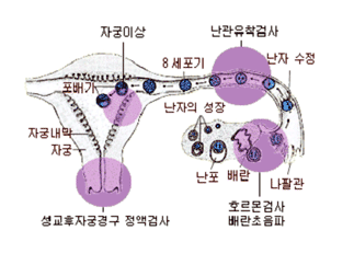 여성난임진단 안내